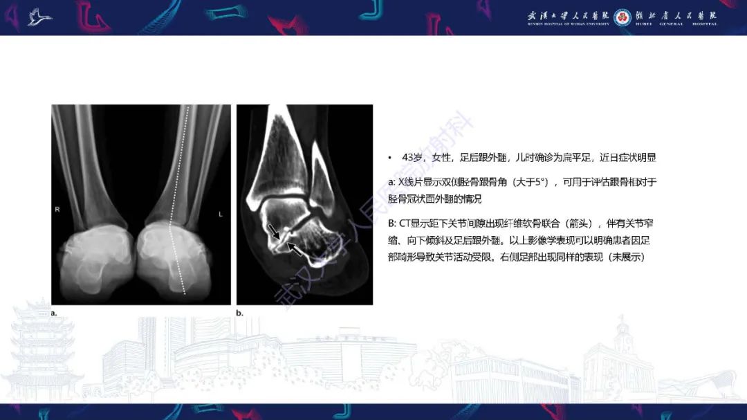 影像PPT - 【PPT】成人获得性扁平足畸形: 解剖学、生物力学、分期和影像学表现-13