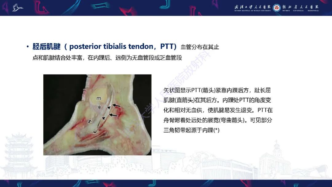 影像PPT - 【PPT】成人获得性扁平足畸形: 解剖学、生物力学、分期和影像学表现-16