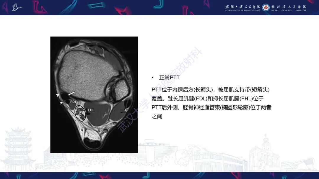 影像PPT - 【PPT】成人获得性扁平足畸形: 解剖学、生物力学、分期和影像学表现-17