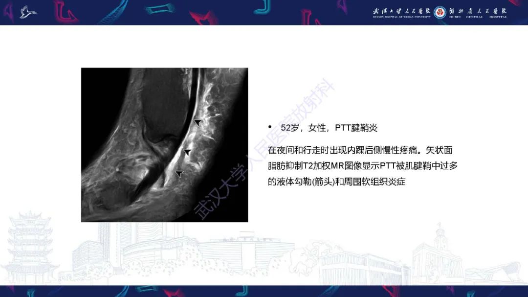影像PPT - 【PPT】成人获得性扁平足畸形: 解剖学、生物力学、分期和影像学表现-19