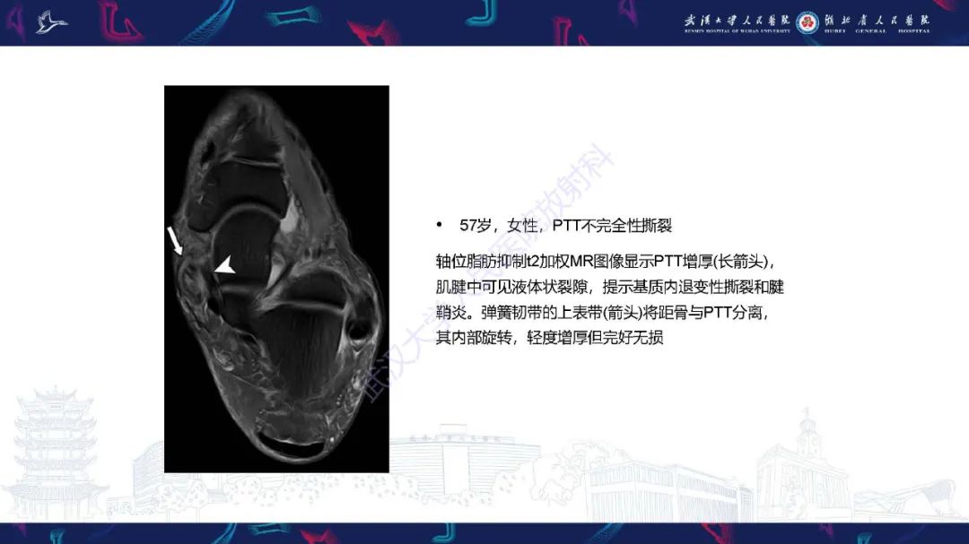 影像PPT - 【PPT】成人获得性扁平足畸形: 解剖学、生物力学、分期和影像学表现-20
