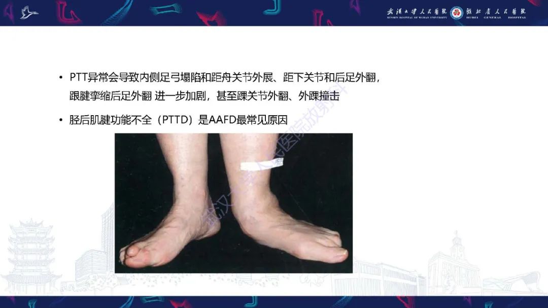 影像PPT - 【PPT】成人获得性扁平足畸形: 解剖学、生物力学、分期和影像学表现-21
