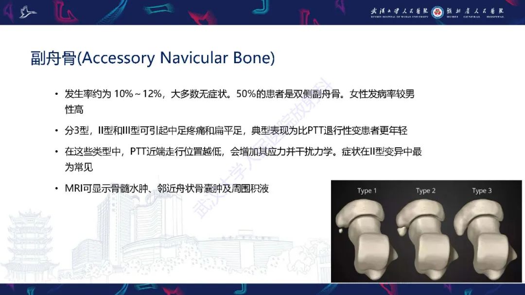 影像PPT - 【PPT】成人获得性扁平足畸形: 解剖学、生物力学、分期和影像学表现-22