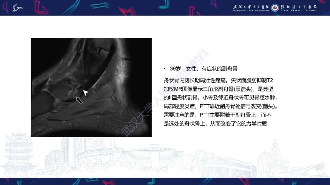 影像PPT - 【PPT】成人获得性扁平足畸形: 解剖学、生物力学、分期和影像学表现-23
