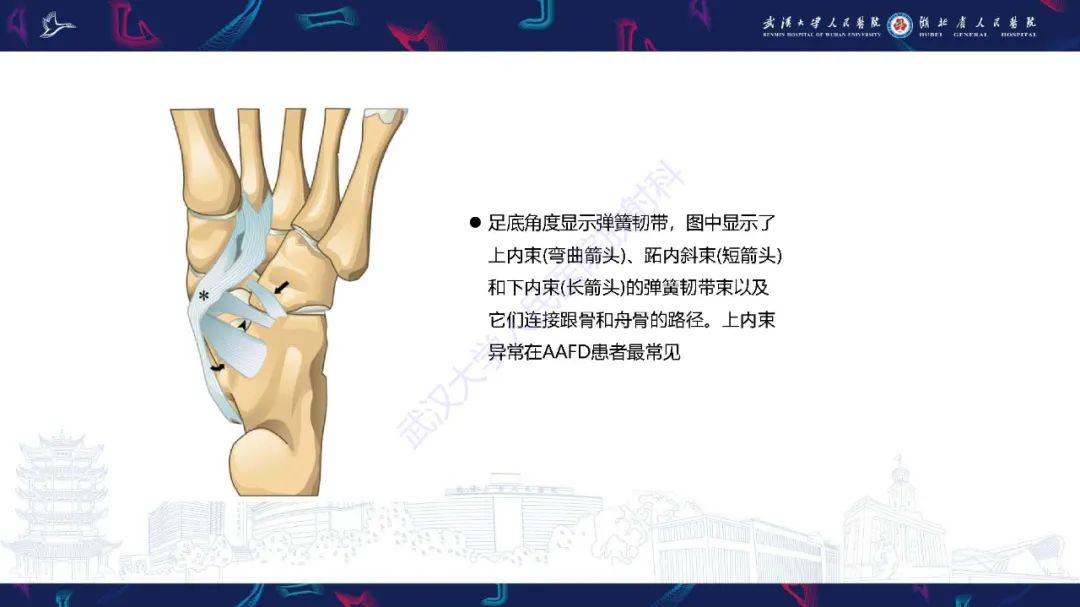 影像PPT - 【PPT】成人获得性扁平足畸形: 解剖学、生物力学、分期和影像学表现-25