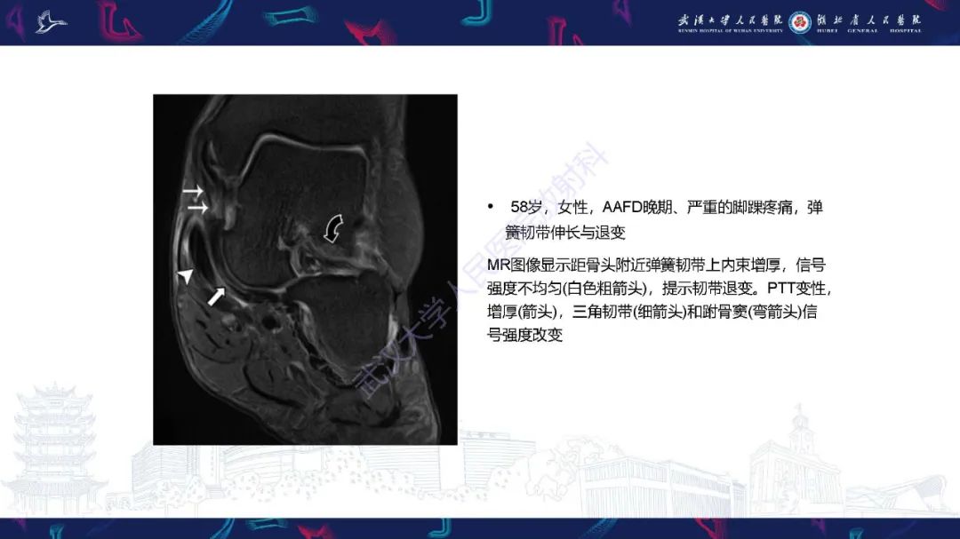 影像PPT - 【PPT】成人获得性扁平足畸形: 解剖学、生物力学、分期和影像学表现-26