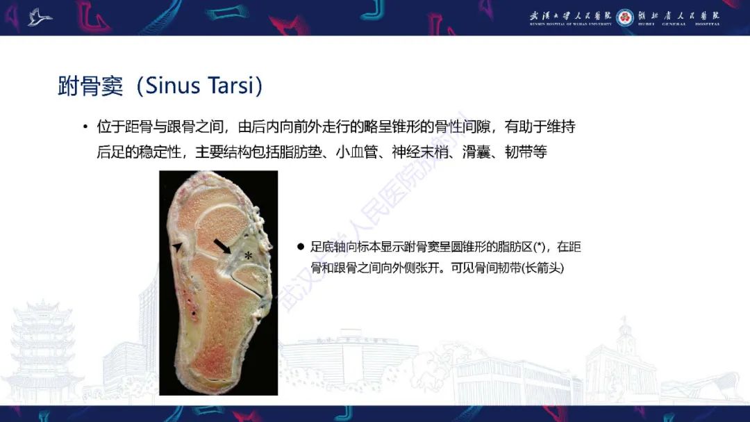 影像PPT - 【PPT】成人获得性扁平足畸形: 解剖学、生物力学、分期和影像学表现-27
