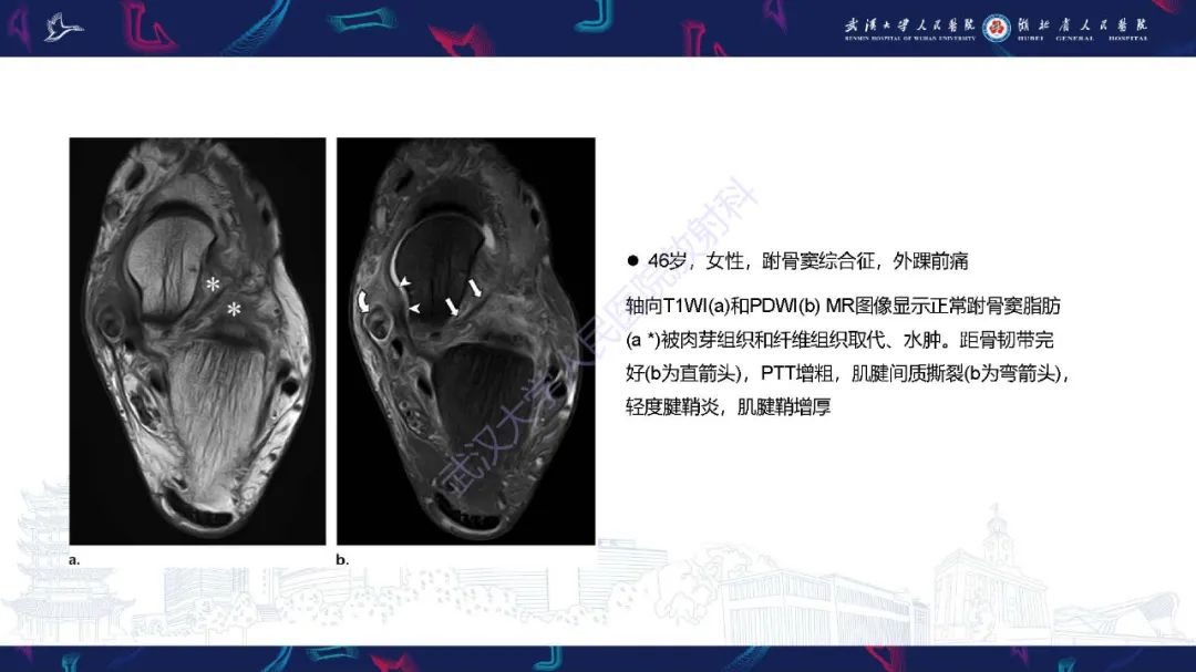 影像PPT - 【PPT】成人获得性扁平足畸形: 解剖学、生物力学、分期和影像学表现-29