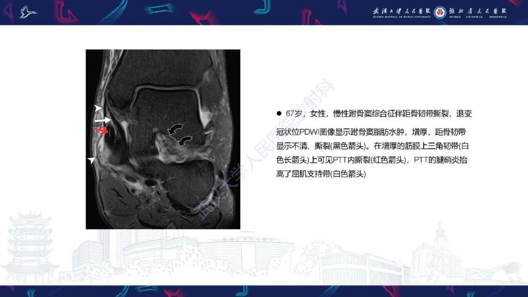 影像PPT - 【PPT】成人获得性扁平足畸形: 解剖学、生物力学、分期和影像学表现-30