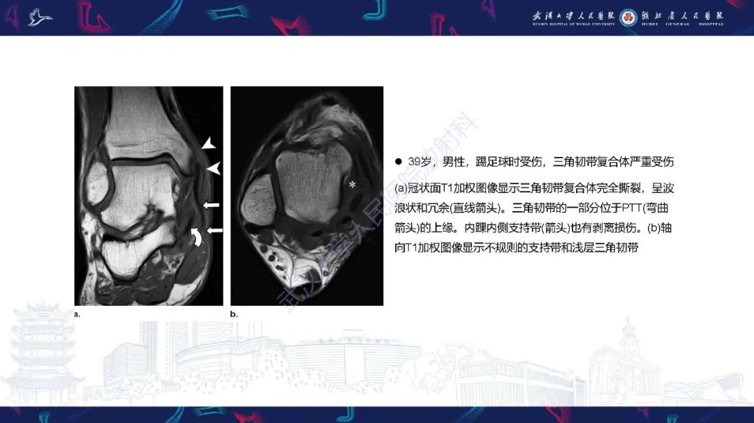 影像PPT - 【PPT】成人获得性扁平足畸形: 解剖学、生物力学、分期和影像学表现-32