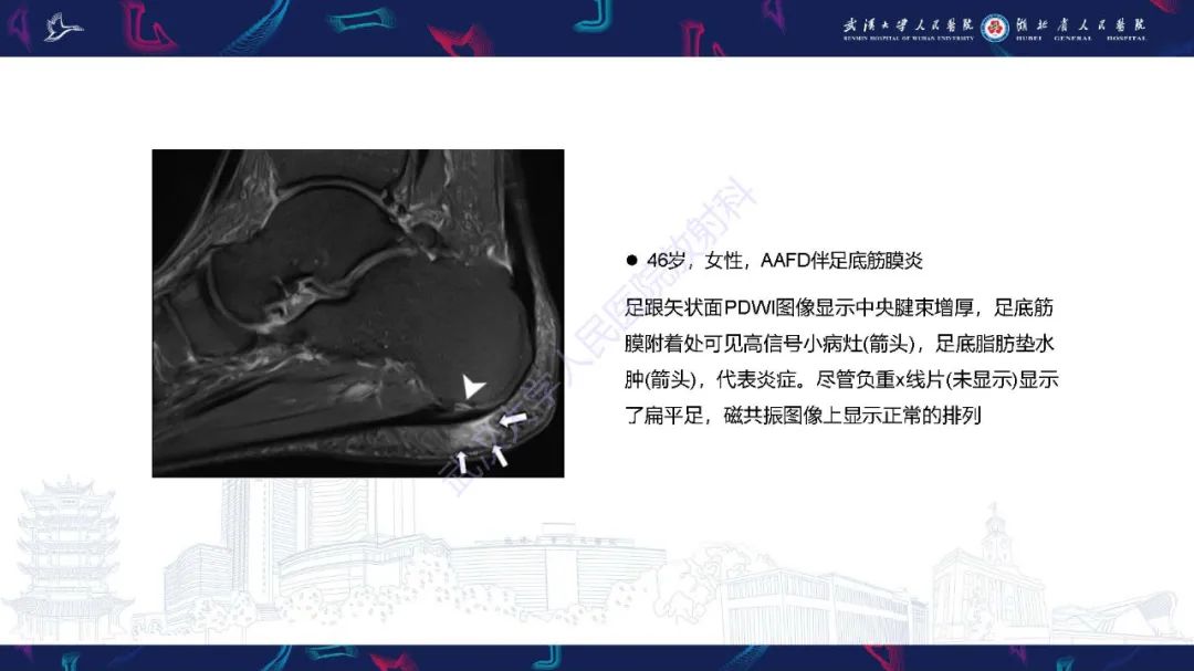 影像PPT - 【PPT】成人获得性扁平足畸形: 解剖学、生物力学、分期和影像学表现-35