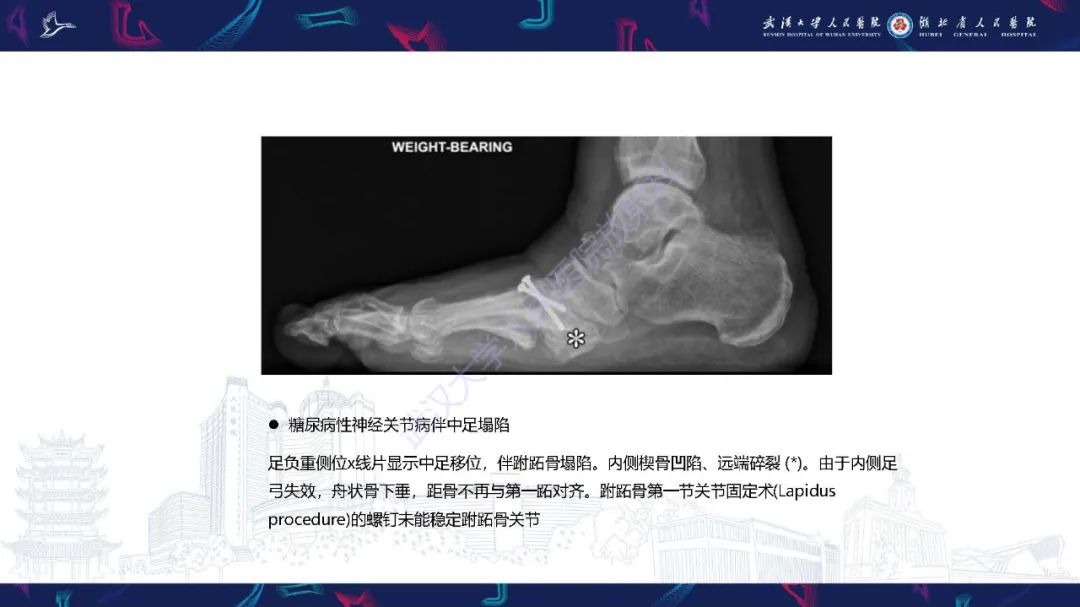影像PPT - 【PPT】成人获得性扁平足畸形: 解剖学、生物力学、分期和影像学表现-37
