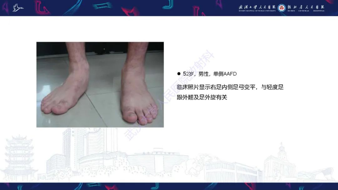 影像PPT - 【PPT】成人获得性扁平足畸形: 解剖学、生物力学、分期和影像学表现-42