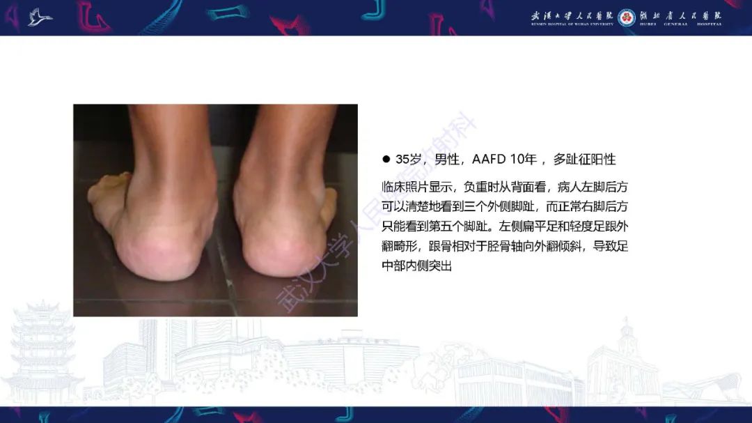 影像PPT - 【PPT】成人获得性扁平足畸形: 解剖学、生物力学、分期和影像学表现-43