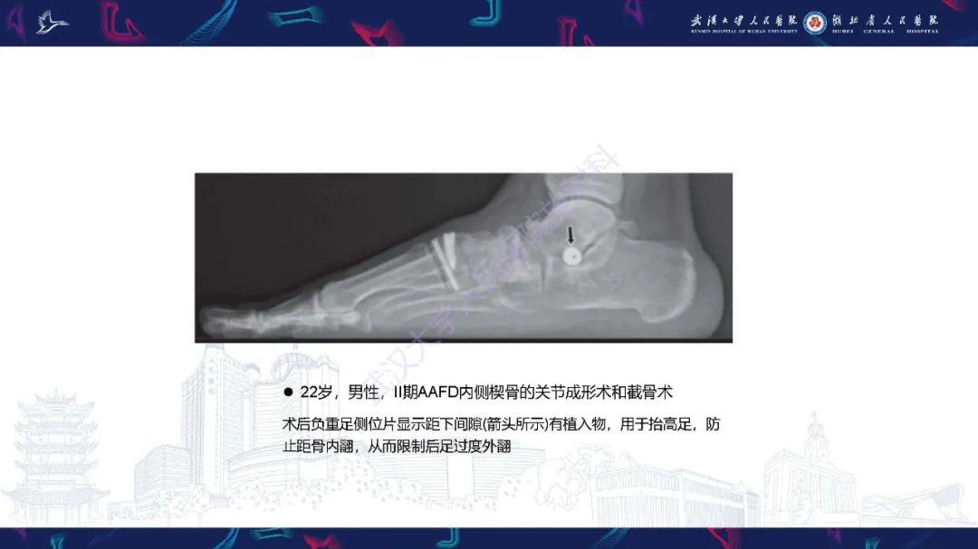 影像PPT - 【PPT】成人获得性扁平足畸形: 解剖学、生物力学、分期和影像学表现-44