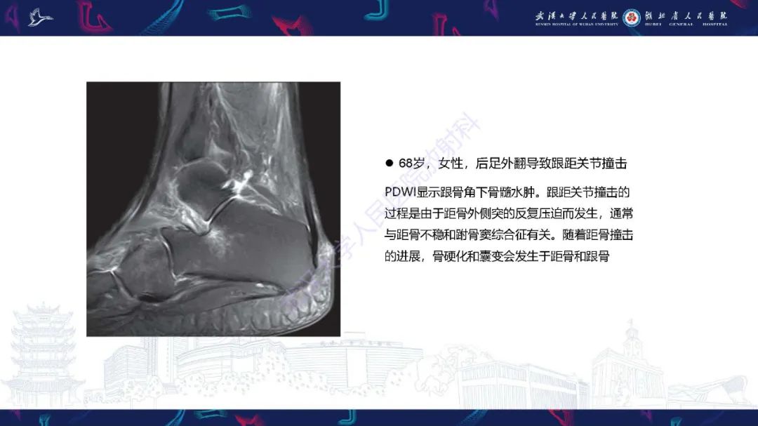 影像PPT - 【PPT】成人获得性扁平足畸形: 解剖学、生物力学、分期和影像学表现-46