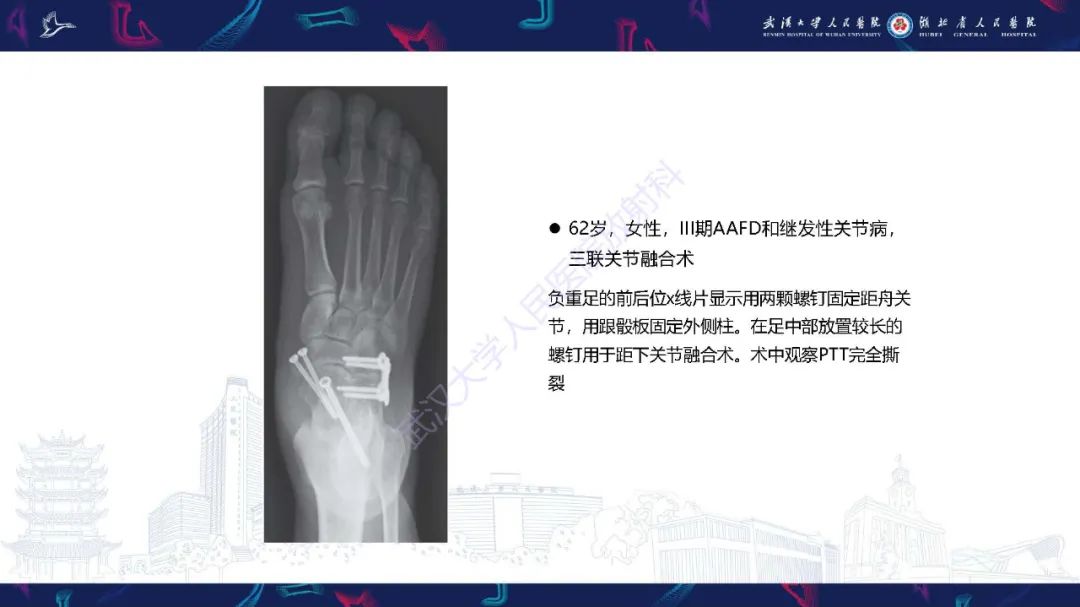 影像PPT - 【PPT】成人获得性扁平足畸形: 解剖学、生物力学、分期和影像学表现-47