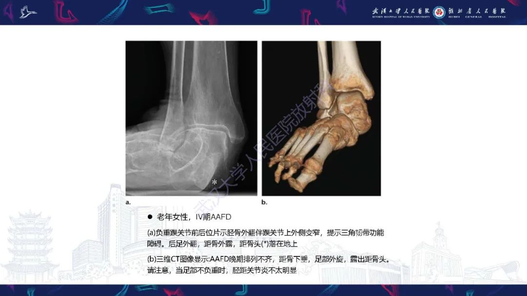 影像PPT - 【PPT】成人获得性扁平足畸形: 解剖学、生物力学、分期和影像学表现-49