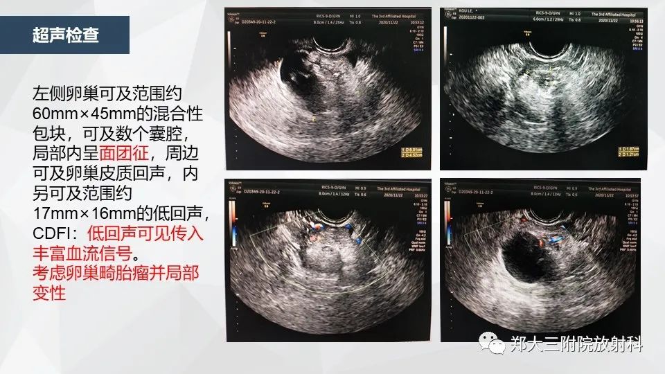 影像PPT - 【病例】卵巢畸胎瘤1例诊断思路-3