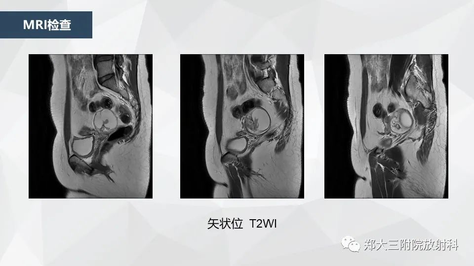 影像PPT - 【病例】卵巢畸胎瘤1例诊断思路-4