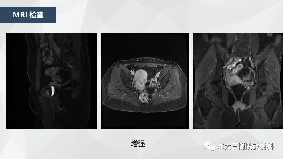 影像PPT - 【病例】卵巢畸胎瘤1例诊断思路-8