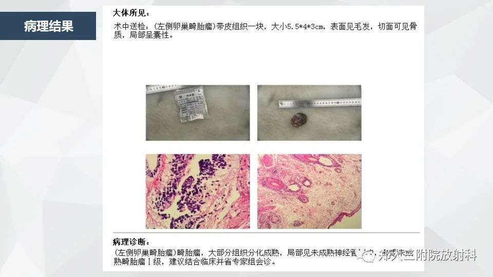 影像PPT - 【病例】卵巢畸胎瘤1例诊断思路-10
