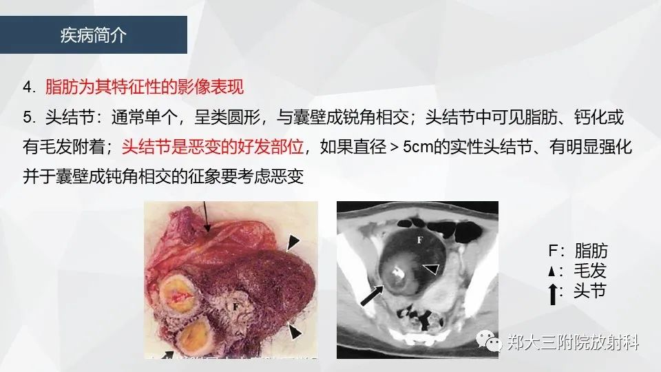 影像PPT - 【病例】卵巢畸胎瘤1例诊断思路-15