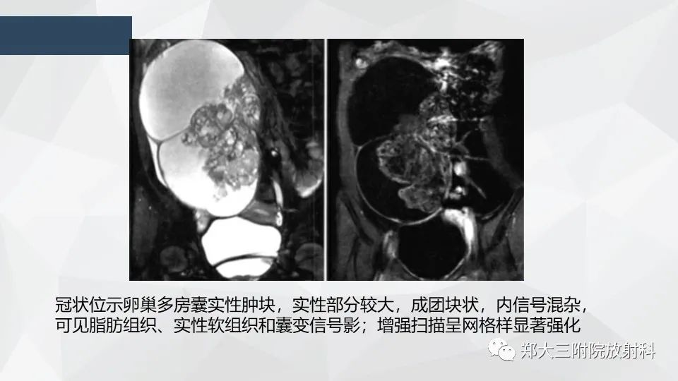 影像PPT - 【病例】卵巢畸胎瘤1例诊断思路-17