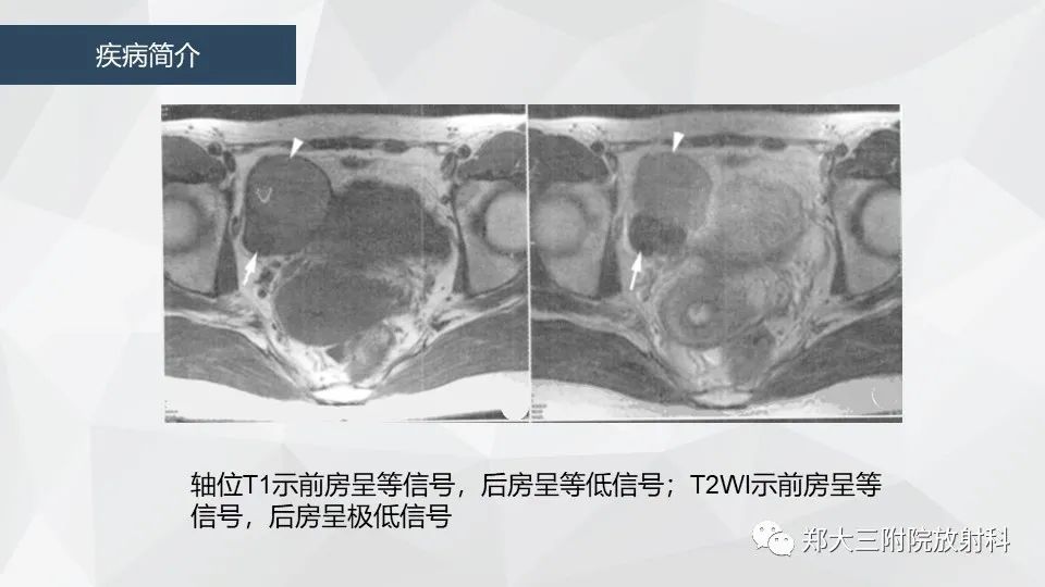 影像PPT - 【病例】卵巢畸胎瘤1例诊断思路-19