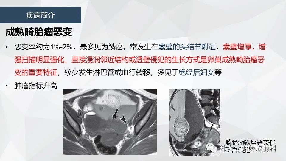 影像PPT - 【病例】卵巢畸胎瘤1例诊断思路-20