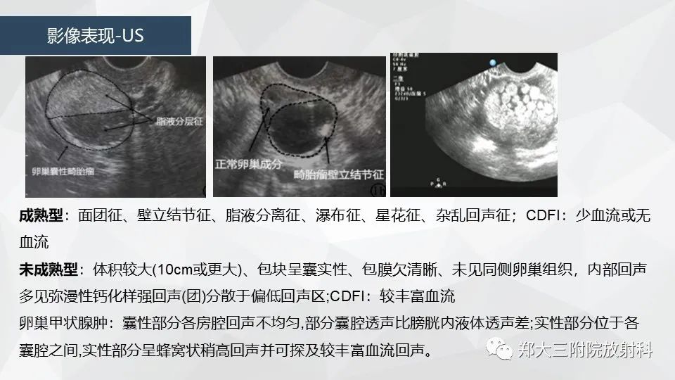 影像PPT - 【病例】卵巢畸胎瘤1例诊断思路-22