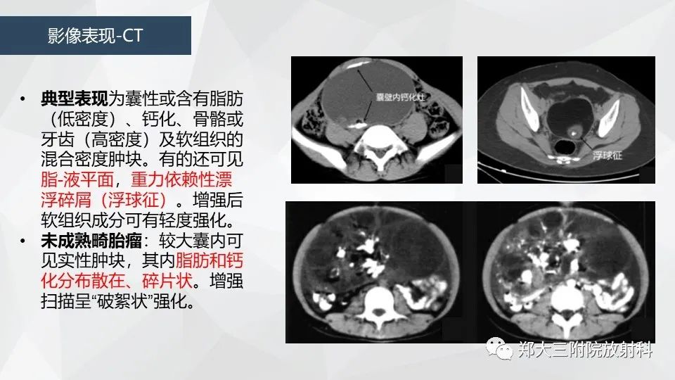 影像PPT - 【病例】卵巢畸胎瘤1例诊断思路-23