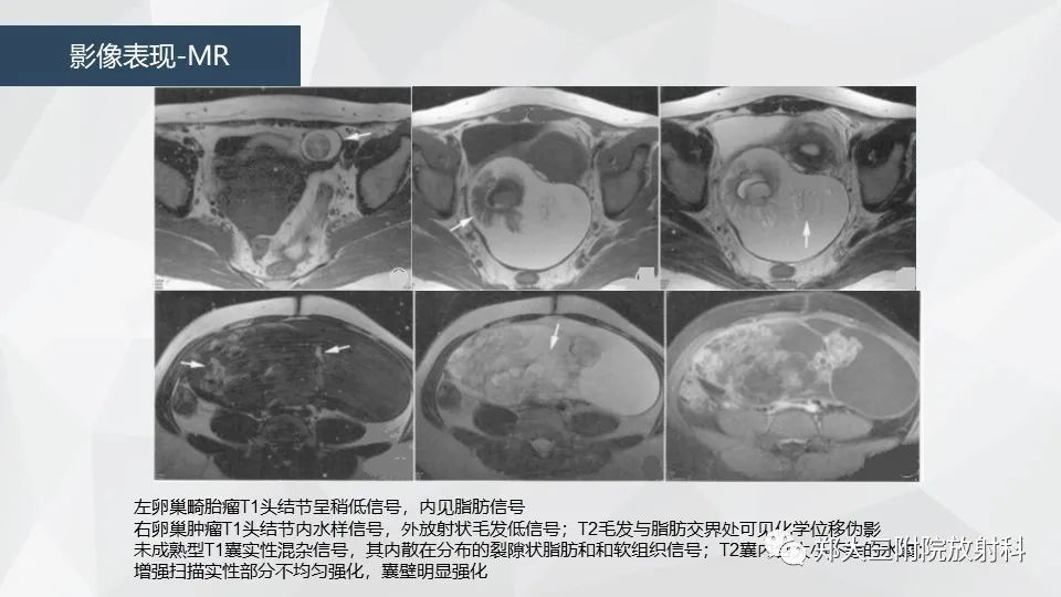 影像PPT - 【病例】卵巢畸胎瘤1例诊断思路-25