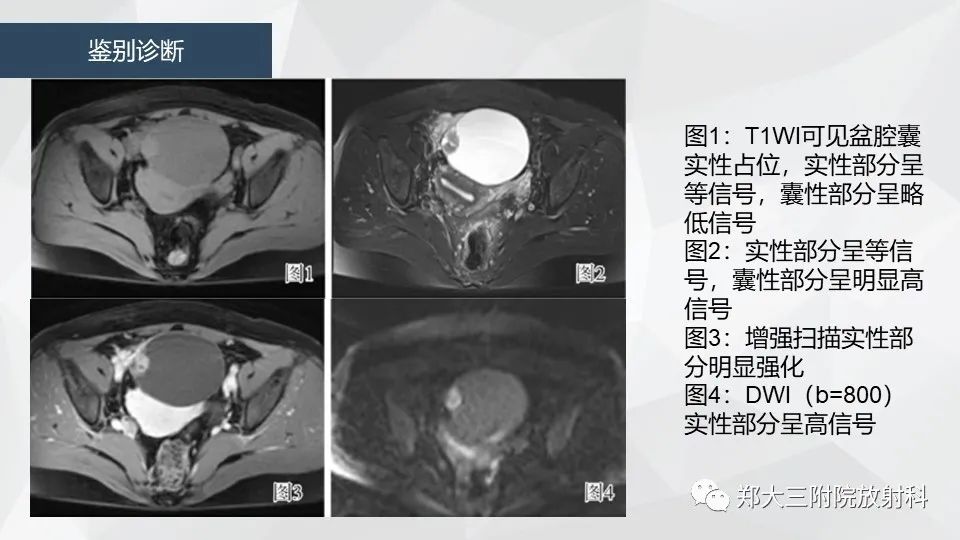 影像PPT - 【病例】卵巢畸胎瘤1例诊断思路-28