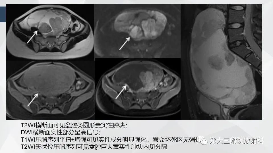 影像PPT - 【病例】卵巢畸胎瘤1例诊断思路-31