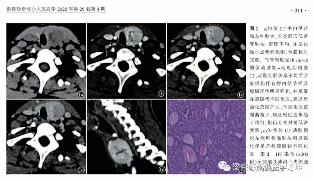 影像PPT - 【病例】甲状腺腺瘤1例影像诊断思维-4