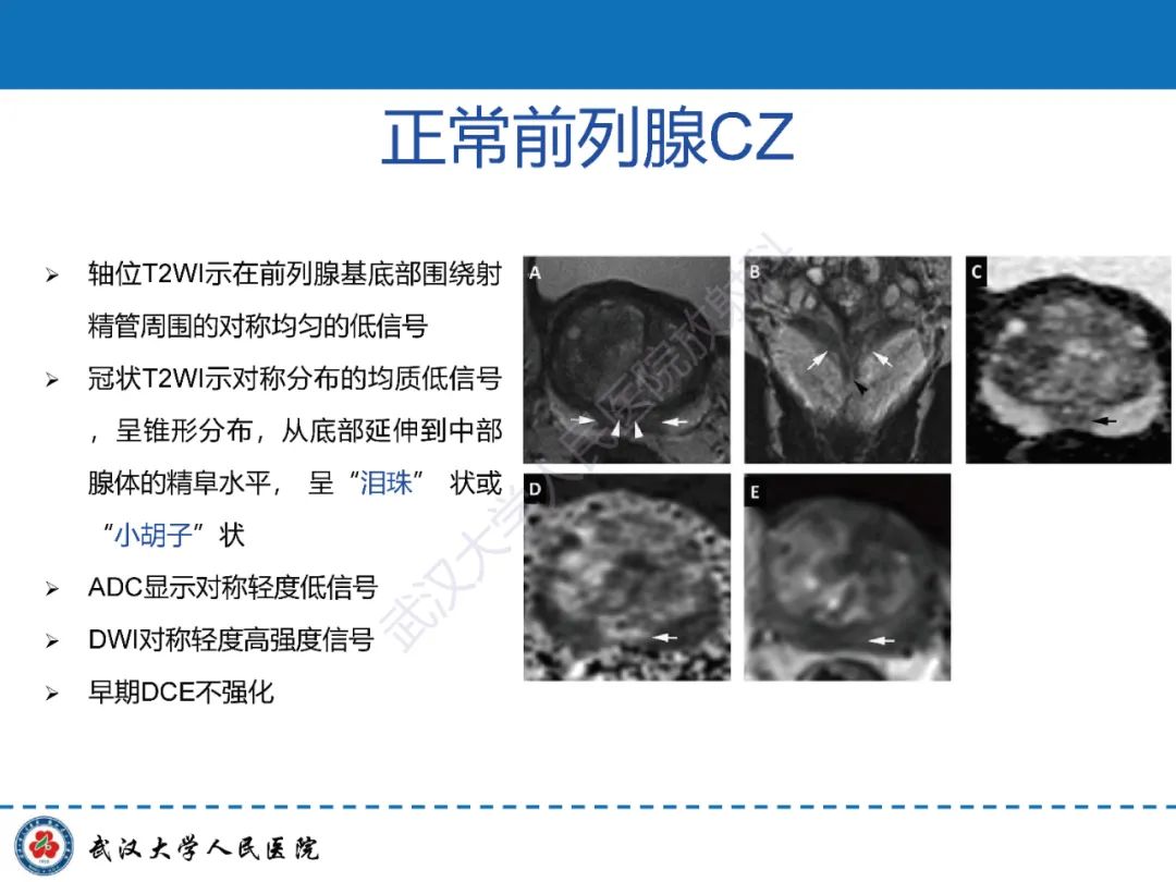 影像PPT - 【PPT】前列腺PI-RADS 2.1版本更新解读-16
