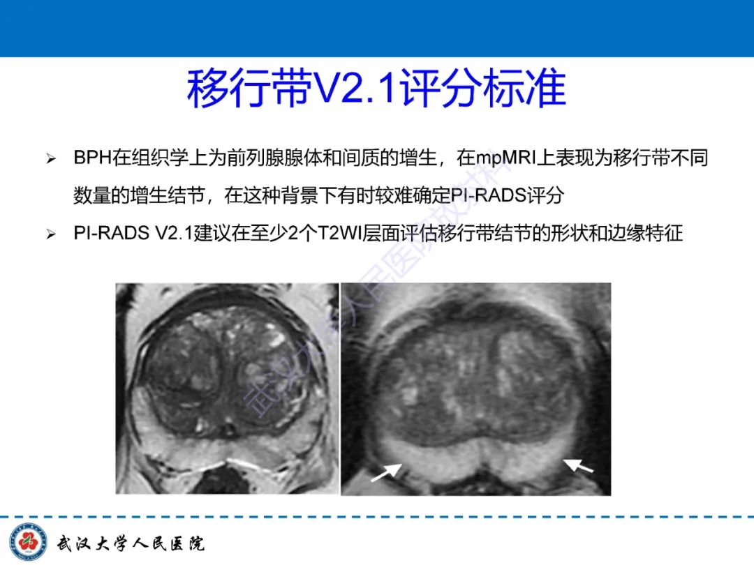 影像PPT - 【PPT】前列腺PI-RADS 2.1版本更新解读-23