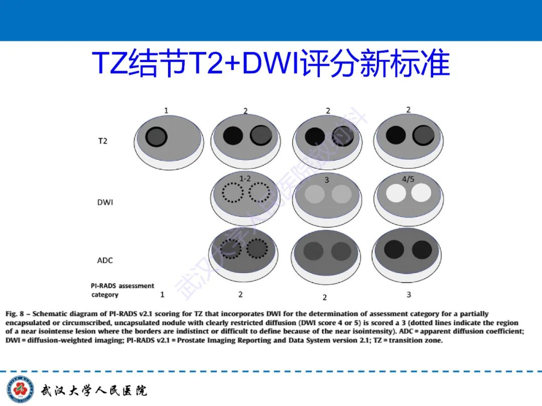 影像PPT - 【PPT】前列腺PI-RADS 2.1版本更新解读-30
