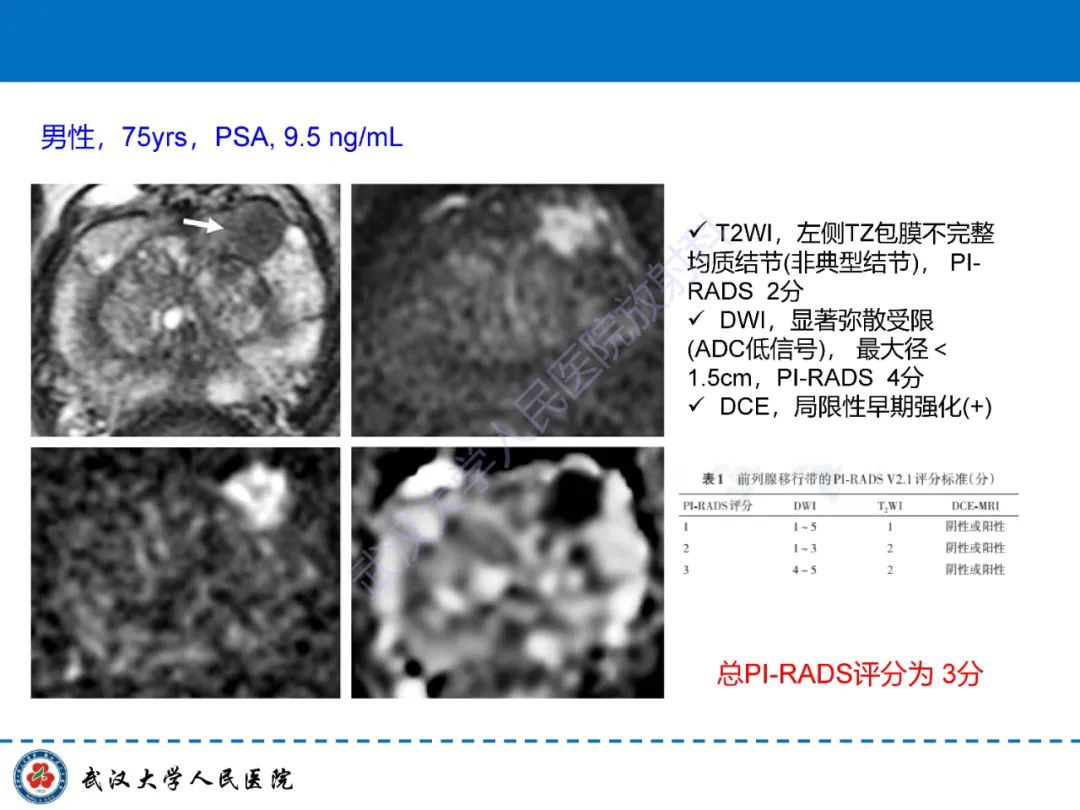 影像PPT - 【PPT】前列腺PI-RADS 2.1版本更新解读-32
