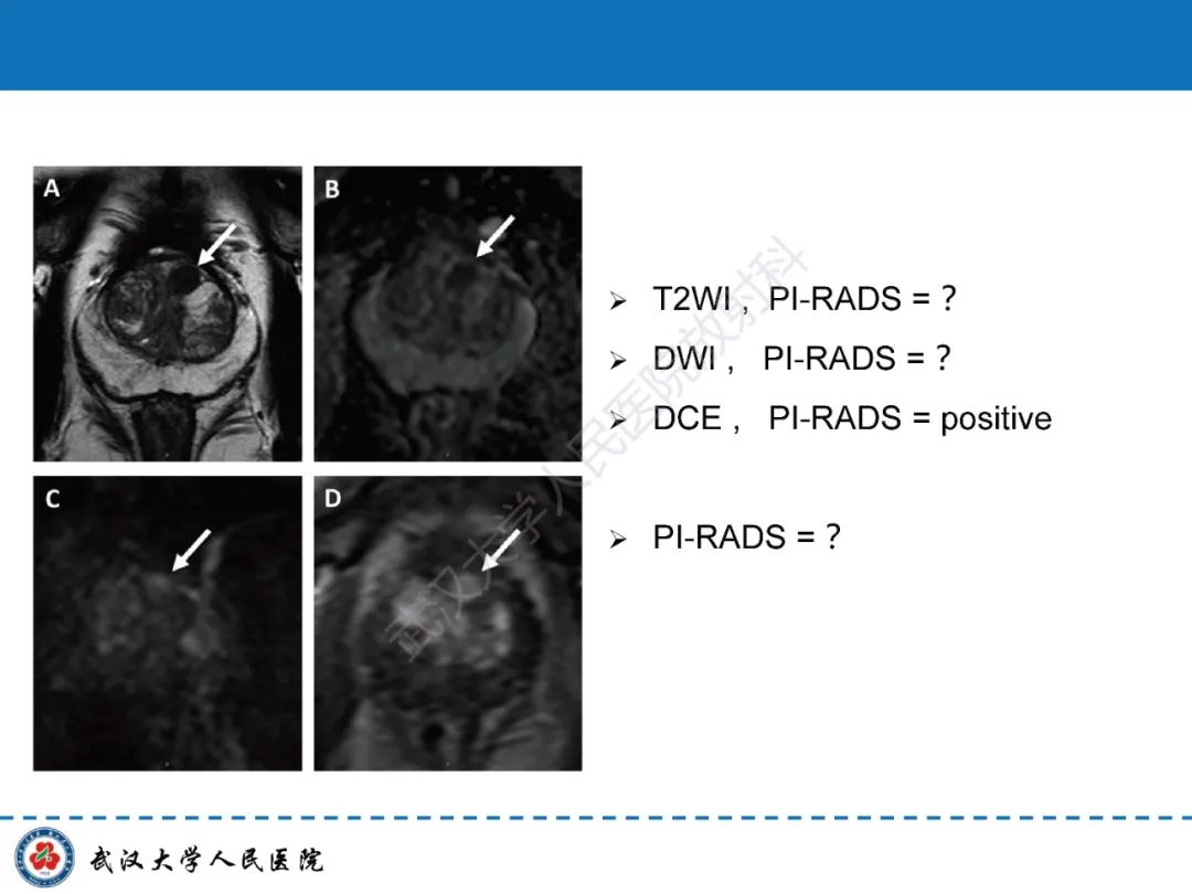 影像PPT - 【PPT】前列腺PI-RADS 2.1版本更新解读-33