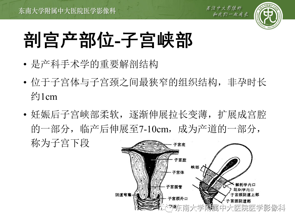 影像PPT - 【PPT】剖宫产瘢痕妊娠-3
