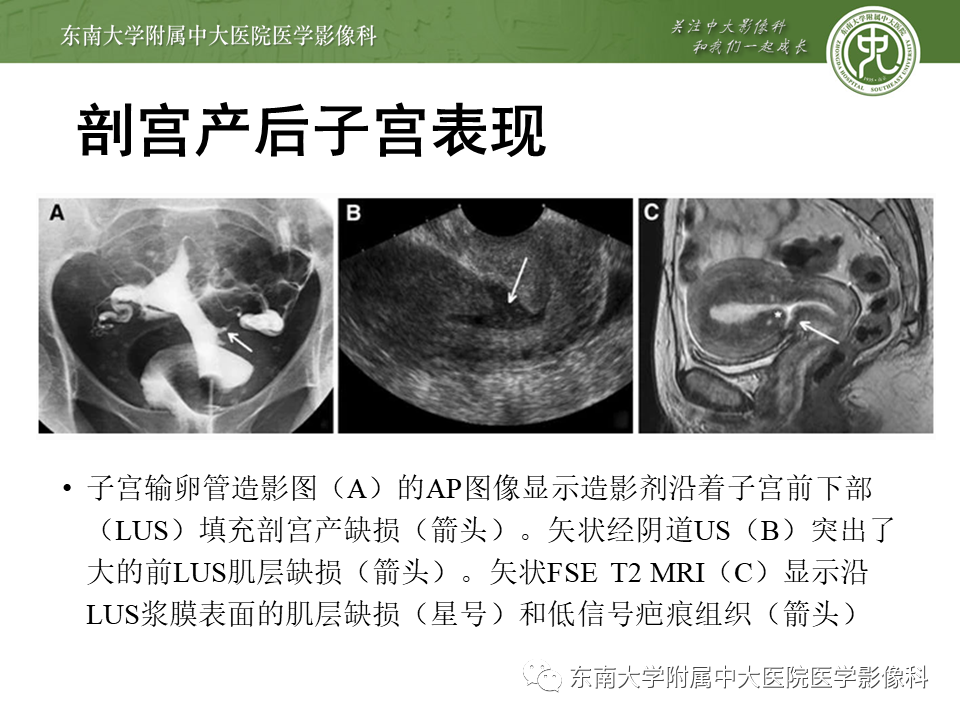 影像PPT - 【PPT】剖宫产瘢痕妊娠-4