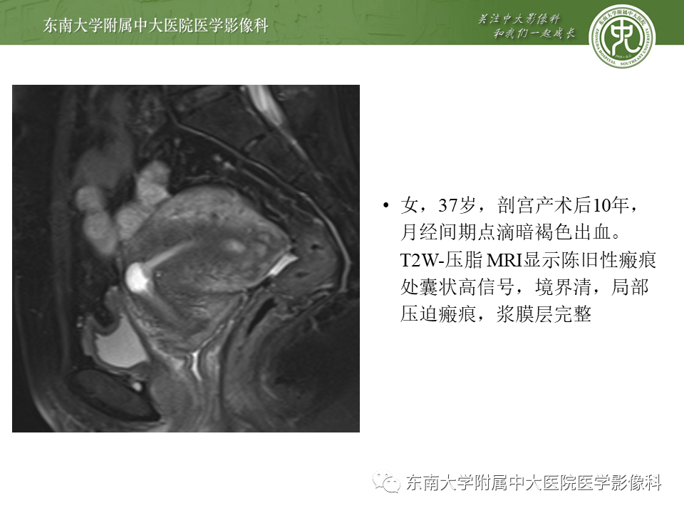 影像PPT - 【PPT】剖宫产瘢痕妊娠-7