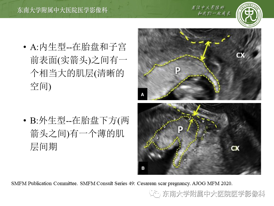 影像PPT - 【PPT】剖宫产瘢痕妊娠-11