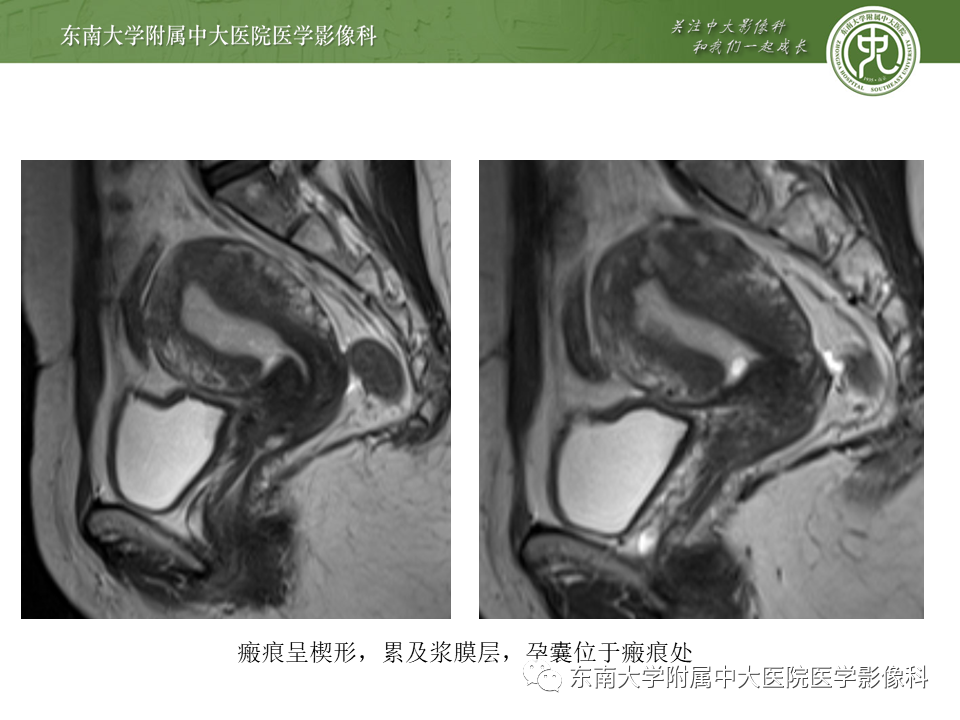 影像PPT - 【PPT】剖宫产瘢痕妊娠-16