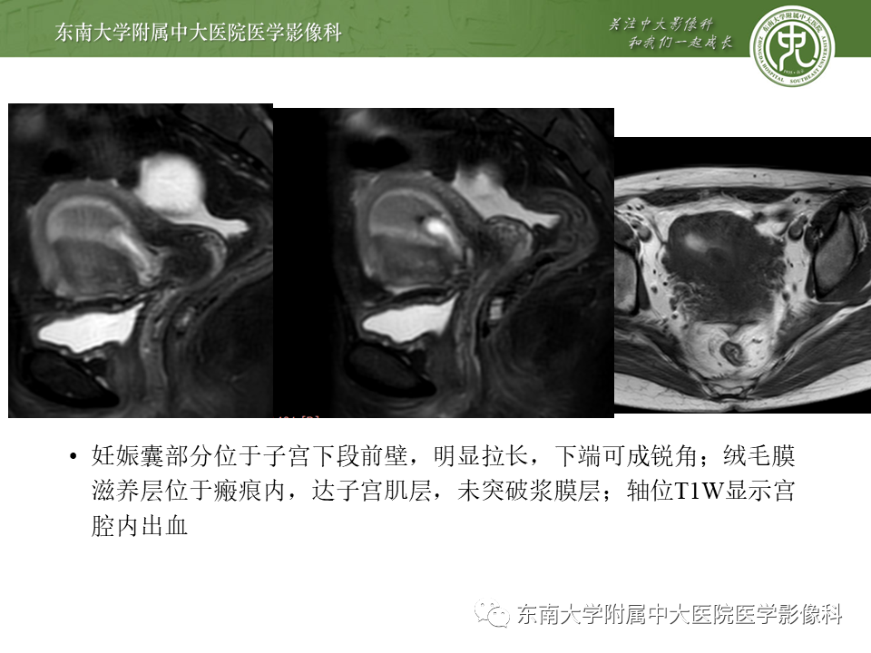 影像PPT - 【PPT】剖宫产瘢痕妊娠-17