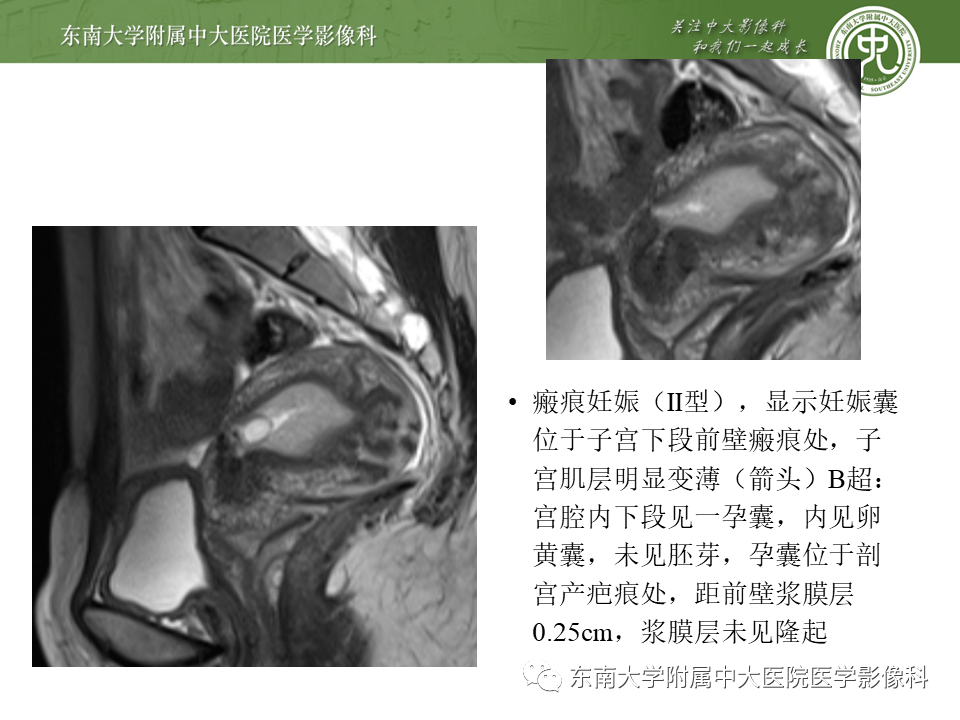 影像PPT - 【PPT】剖宫产瘢痕妊娠-18