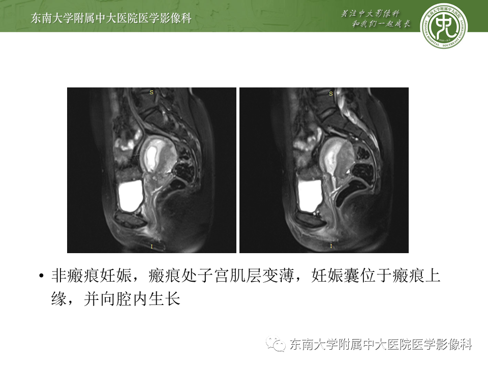 影像PPT - 【PPT】剖宫产瘢痕妊娠-19