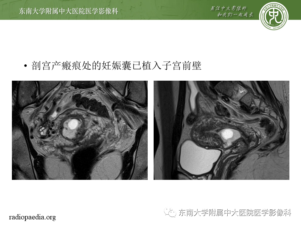 影像PPT - 【PPT】剖宫产瘢痕妊娠-20